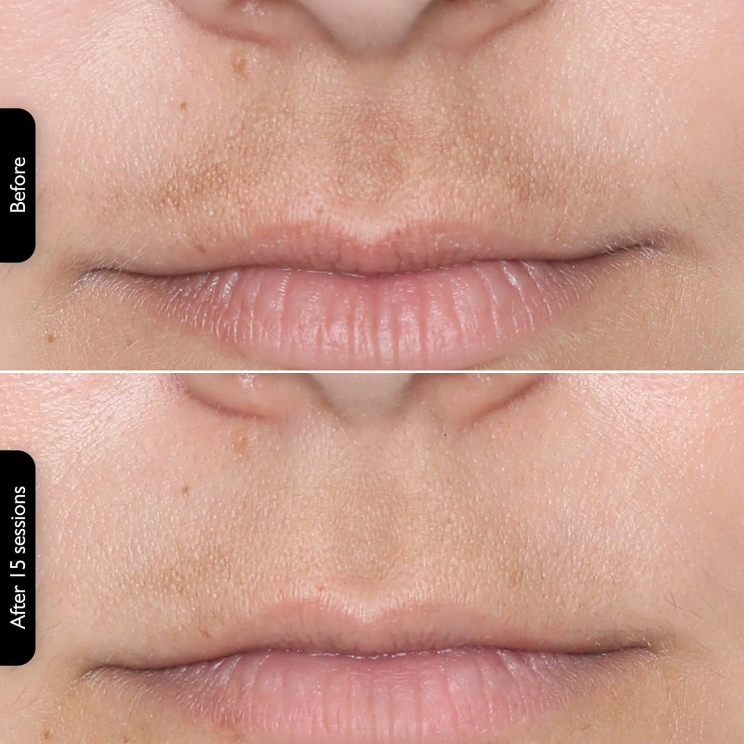 LEDMask | Amélioration de la peau avec la technologie LED